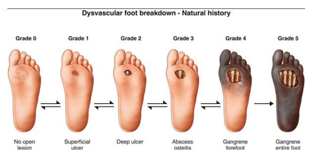 Click here to know about different stages of diabetic foot ulcer –  HappyWalk - Orthopedic & Diabetic Footwear Store